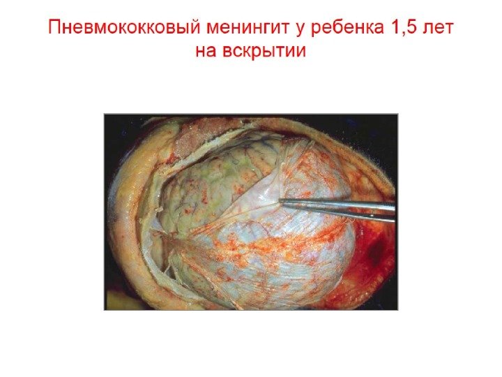 Пневмококковый менингит у ребенка 1, 5 лет на вскрытии 